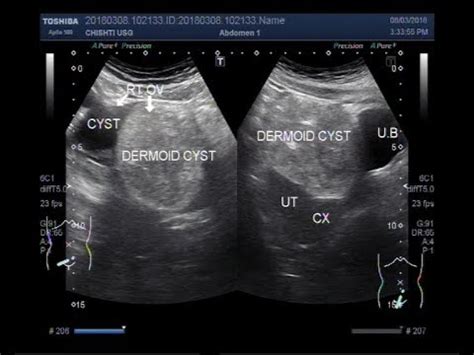 Ultrasound Video showing a simple ovarian cyst and a Dermoid ovarian cyst. - YouTube