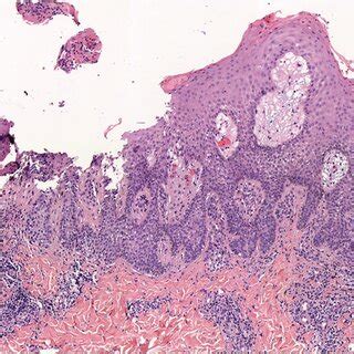 Biopsy of one of the lesions revealed nevus cells arranged in small ...