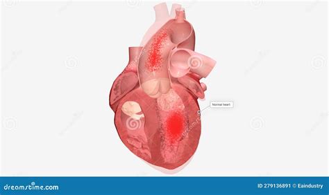 Cardiomyopathy is a Disease of the Heart Muscle that Causes the Stock Illustration ...