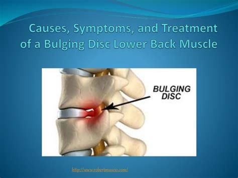 Causes, Symptoms, and Treatment of a Bulging Disc Lower Back Muscle