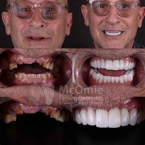 Options for Full Mouth Reconstruction - McOmie Dentistry Chattanooga