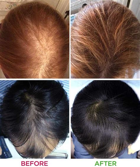 Laser Light For Hair Growth: What Is It And Does It Work? - Woman and Wellness