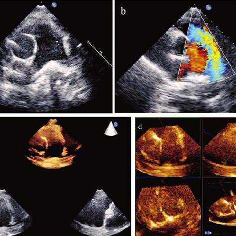 Echocardiography views: a) 2D Echo: Short axis showing markedly dilated ...