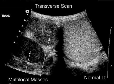 Testicular Cancer | Division of Urologic Surgery | Washington University in St. Louis