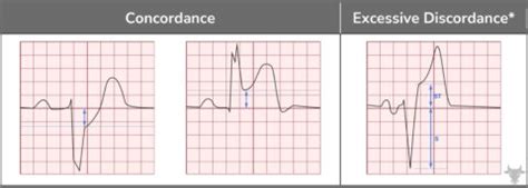 Sgarbossa Criteria | ECG Stampede