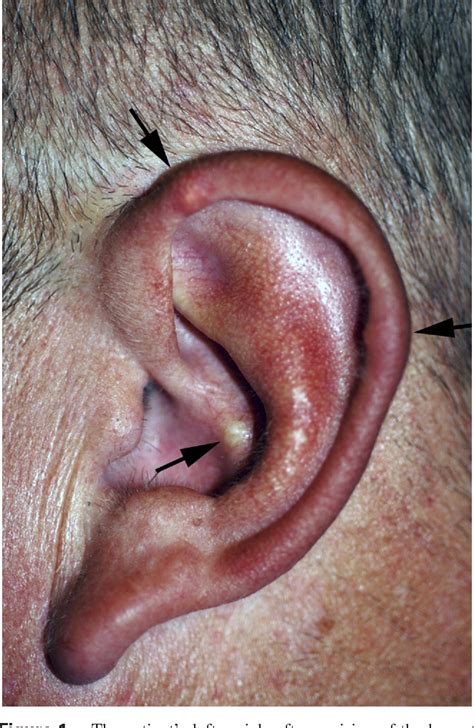 Figure 1 from Auricular tophi as the initial presentation of gout | Semantic Scholar