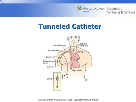 Tunneled Central Venous Catheter Placement