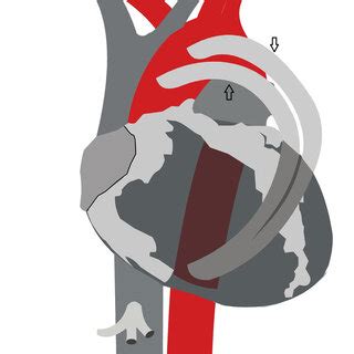 Hemashield Y graft was implanted to descending aorta with end-to-side ...