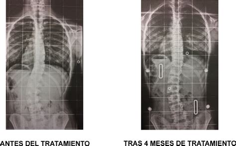 Escoliosis lumbar: un caso práctico - www.medspine.es