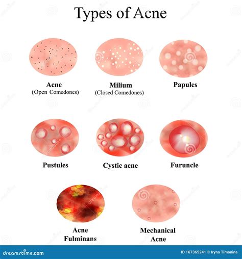 Papules. Acne On The Skin. Dermatological And Cosmetic Diseases On The ...