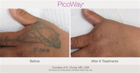 PicoWay Laser Tattoo Removal – Synergy Medical Aesthetics – Nanaimo, Victoria, Vancouver Island