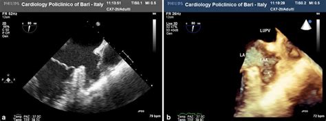 Pectinate muscles in the apex of left atrial appendage. Two-dimensional ...