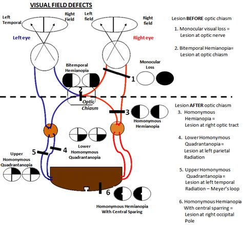 Image result for visual field defects | Medical textbooks, Medical ...