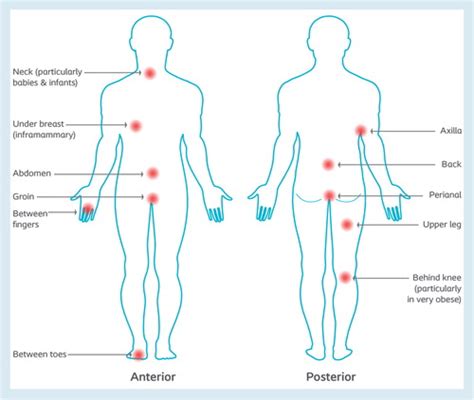 The diagnosis, management and prevention of intertrigo in adults: a review | Journal of Wound Care