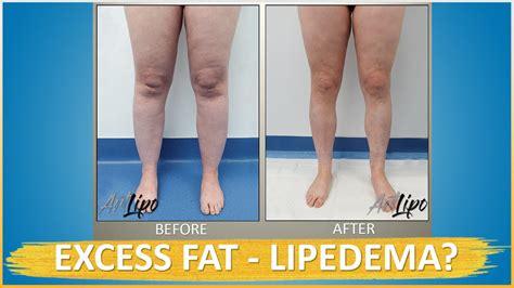 Lipo 360° Legs | Immediate Results | Lipedema Surgery | Cankles & Knees | Expert Dr. Thomas Su ...