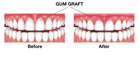 Gum Grafting Procedure | Gum Surgery Birmingham, AL Periodontist - Periodontist in Birmingham ...