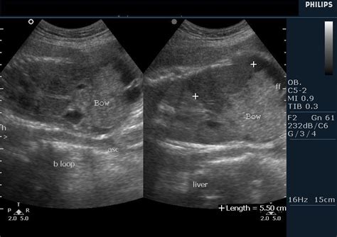 Echogenic Fetal Bowel Ultrasound Services in Ernakulam | ID: 8454649288