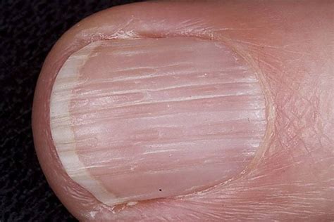 How Your Fingernails Are Trying To Warn You About Your Health