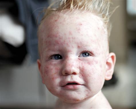 Chickenpox: No Adults Allowed - Medical Forum