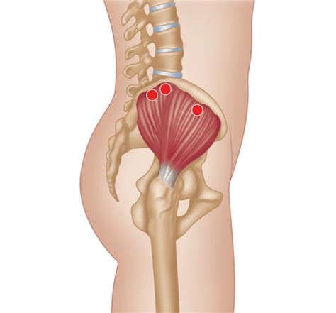 Treating Gluteus Medius Trigger Points - Stretching | Gluteus Muscles ...