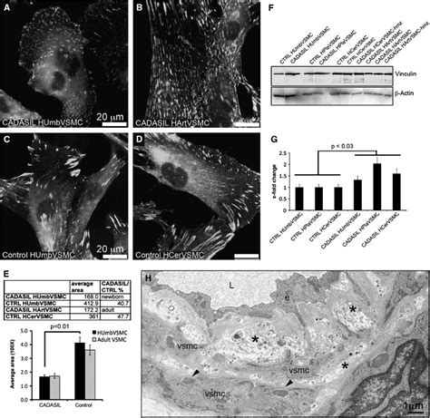 Vinculin positive adhesion sites in CADASIL vascular smooth muscle ...