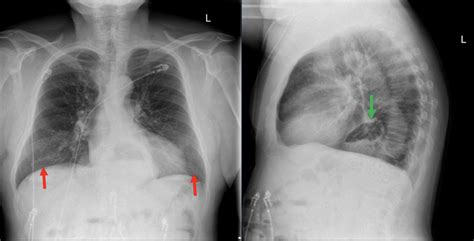 Incidental Hiatal Hernia on Chest X-ray - JETem