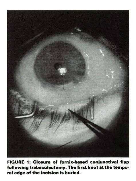 Glaucoma Filtration Surgery: New Horizontal Mattress Closure of Conjunctival Incision