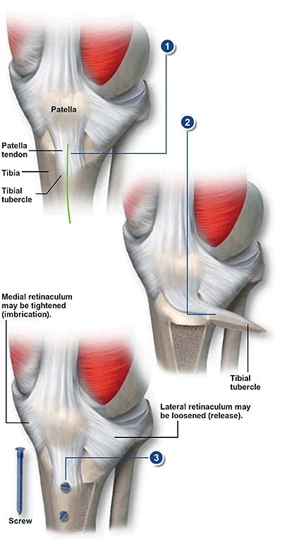 Tibial Tubercle Osteotomy | Central Coast Orthopedic Medical Group