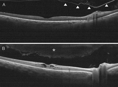 Optical coherence tomographic findings in PVD and false positive PVD... | Download Scientific ...