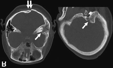 Case 2. Computed tomography scans showing a left upper pyramidal bone ...