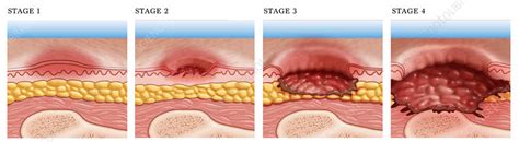 Stages Of Skin Ulcers