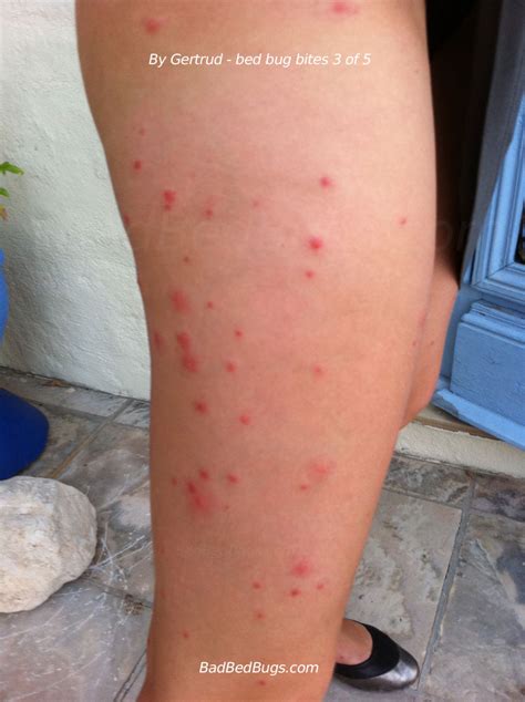 Side view of legs bitten by bed bugs