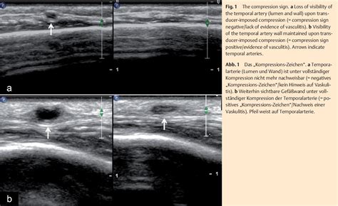 Figure 1 from Temporal artery compression sign--a novel ultrasound ...