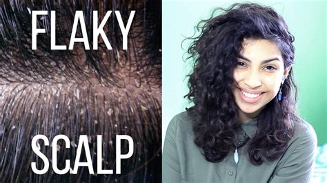 Causes + Fixes to a Flaky Scalp - YouTube