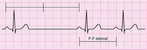 Arritmias En El Electrocardiograma Youtube