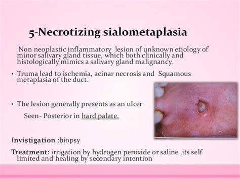 Salivary gland diseases