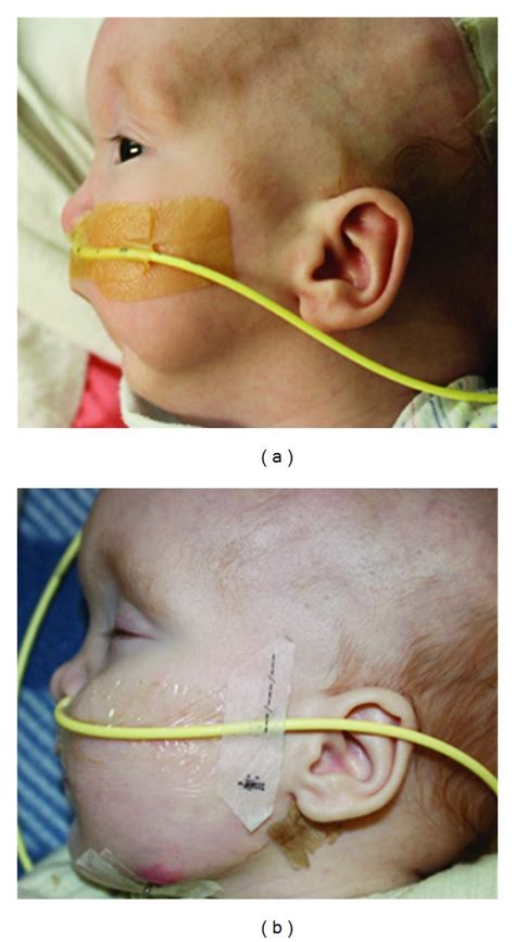 Photographs of an infant with micrognathia and upper airway obstruction ...