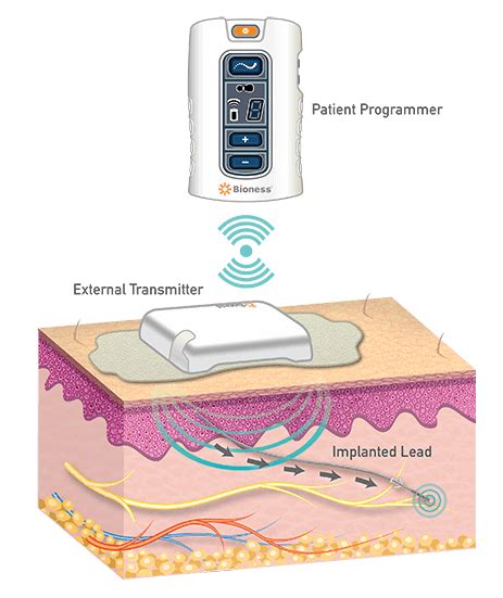 Bioness Peripheral Nerve Stimulator For Chronic Pain In Canada - Implant Surgery & Treatment For ...