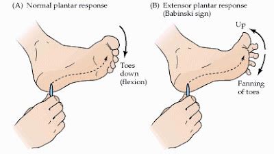 The plantar reflex - Babinski's sign