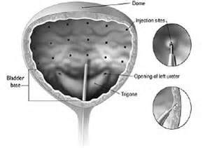 Treatments - Botox Bladder and Pelvic Trigger Point/Block Injections