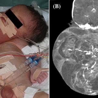 Preoperative MRI of the fi rst baby with cervical teratoma. | Download ...