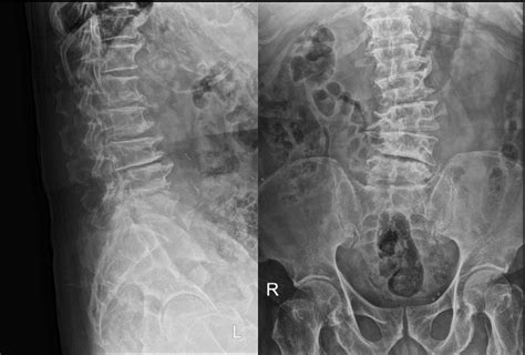 X Ray Lumbosacral Spine Lateral View Showing Radiolog - vrogue.co