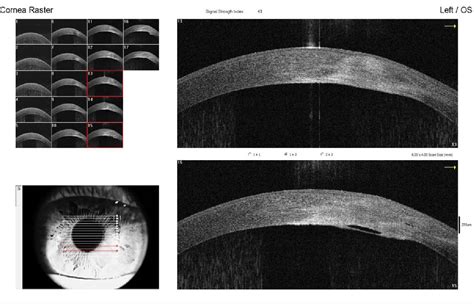 An Overview of Anterior Segment OCT