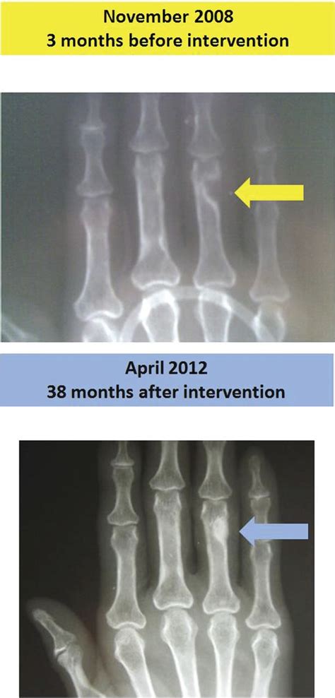 Radiographical appearance of osteitis fibrosa cystica in primary hyperparathyroidism before and ...