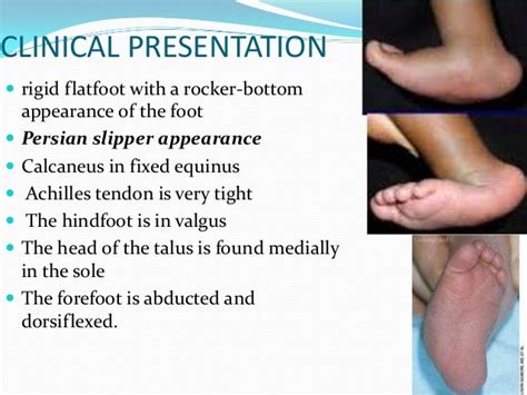 Congenital vertical talus UG lecture