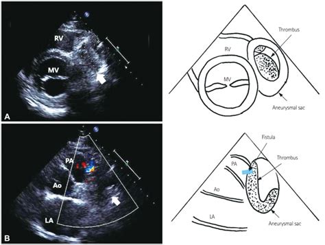 Parasternal Short Axis View Aortic Valve