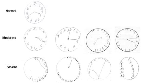 Clock drawing cognitive test should be done routinely in patients with ...