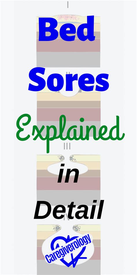 Bed Sores Explained in Detail - Caregiverology | Bed sores, Soreness, Foley catheter