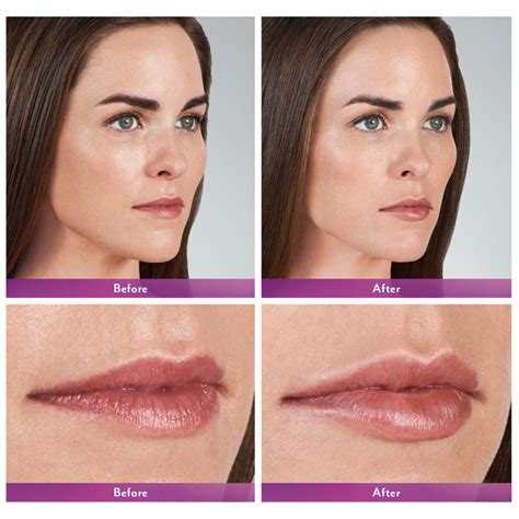 Lip Filler Before and After - Feel Ideal 360 Med Spa - Southlake, TX