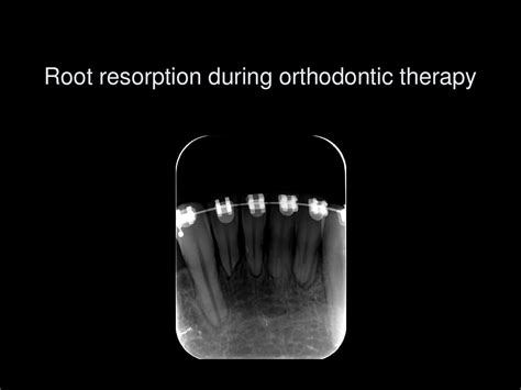 Root resorption during orthodontic therapy by Luc Vrielinck - Issuu